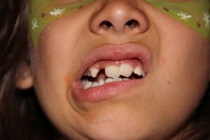 Offener Mädchen-Mund mit schiefen Zähnen